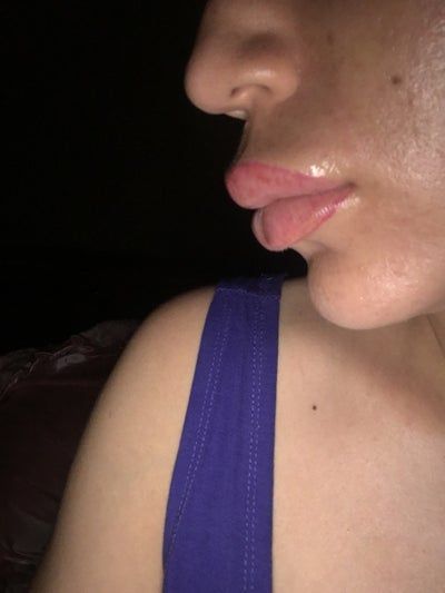 Trẻ hóa khuôn mặt với phương pháp cấy mỡ tự thân vào má, môi, nếp nhăn vùng gian mày, rãnh mũi má và chỉnh sửa mũi lõm