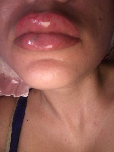 Trẻ hóa khuôn mặt với phương pháp cấy mỡ tự thân vào má, môi, nếp nhăn vùng gian mày, rãnh mũi má và chỉnh sửa mũi lõm