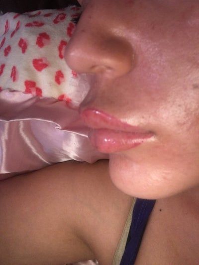 Trẻ hóa khuôn mặt với phương pháp cấy mỡ tự thân vào má, môi, nếp nhăn vùng gian mày, rãnh mũi má và chỉnh sửa mũi lõm