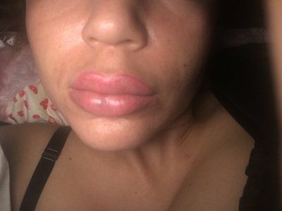 Trẻ hóa khuôn mặt với phương pháp cấy mỡ tự thân vào má, môi, nếp nhăn vùng gian mày, rãnh mũi má và chỉnh sửa mũi lõm