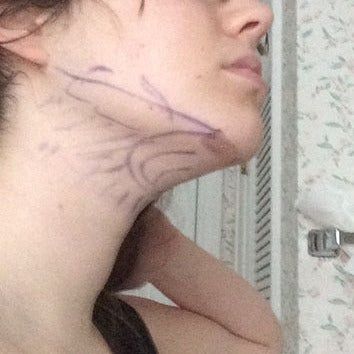 Cô gái trẻ 24 tuổi với quy trình hút mỡ góc cằm cổ