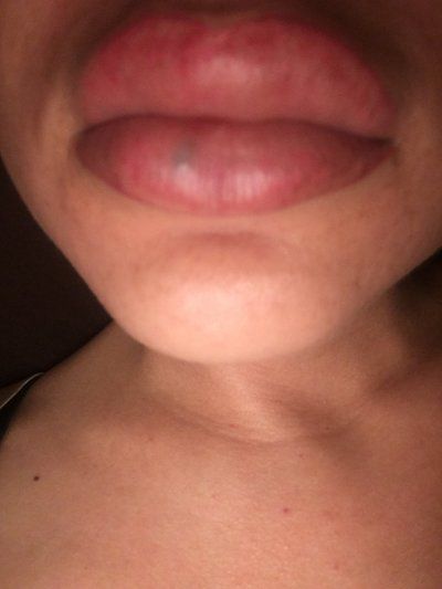 Trẻ hóa khuôn mặt với phương pháp cấy mỡ tự thân vào má, môi, nếp nhăn vùng gian mày, rãnh mũi má và chỉnh sửa mũi lõm