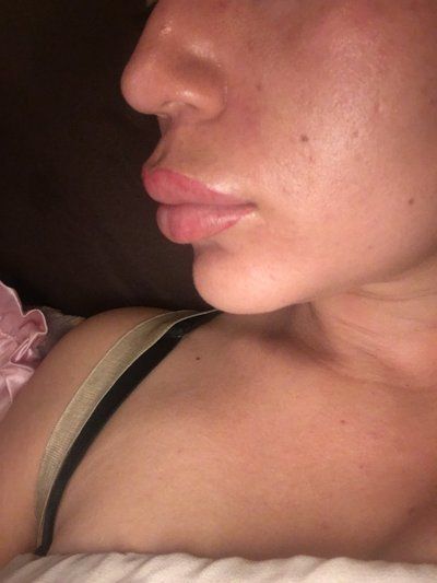 Trẻ hóa khuôn mặt với phương pháp cấy mỡ tự thân vào má, môi, nếp nhăn vùng gian mày, rãnh mũi má và chỉnh sửa mũi lõm