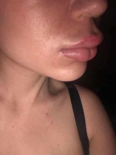 Trẻ hóa khuôn mặt với phương pháp cấy mỡ tự thân vào má, môi, nếp nhăn vùng gian mày, rãnh mũi má và chỉnh sửa mũi lõm