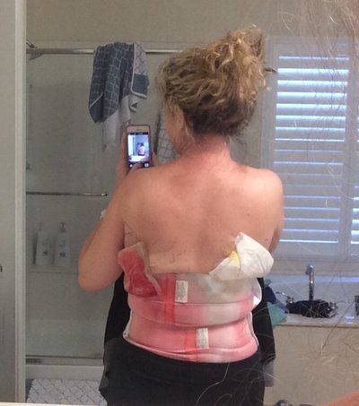 Cùng theo dõi quá trình hút bỡ hai bên hông, sườn và lưng của bà mẹ 46 tuổi