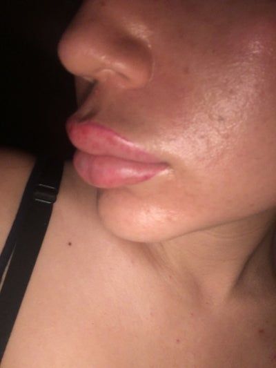 Trẻ hóa khuôn mặt với phương pháp cấy mỡ tự thân vào má, môi, nếp nhăn vùng gian mày, rãnh mũi má và chỉnh sửa mũi lõm