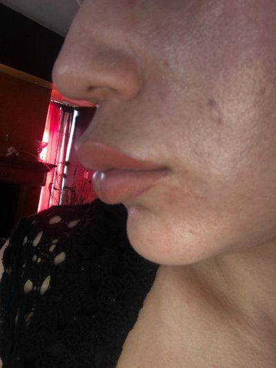 Trẻ hóa khuôn mặt với phương pháp cấy mỡ tự thân vào má, môi, nếp nhăn vùng gian mày, rãnh mũi má và chỉnh sửa mũi lõm