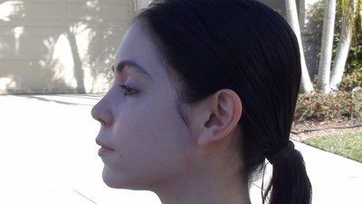 Tự tin sở hữu gương mặt baby đầy đặn với hành trình cấy mỡ tự thân vùng mặt/má và các vùng trũng sâu dưới mắt