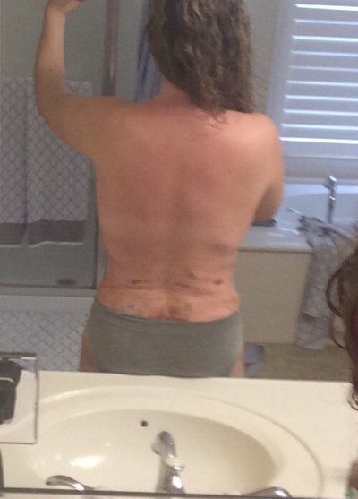 Cùng theo dõi quá trình hút bỡ hai bên hông, sườn và lưng của bà mẹ 46 tuổi