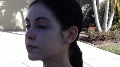 Tự tin sở hữu gương mặt baby đầy đặn với hành trình cấy mỡ tự thân vùng mặt/má và các vùng trũng sâu dưới mắt