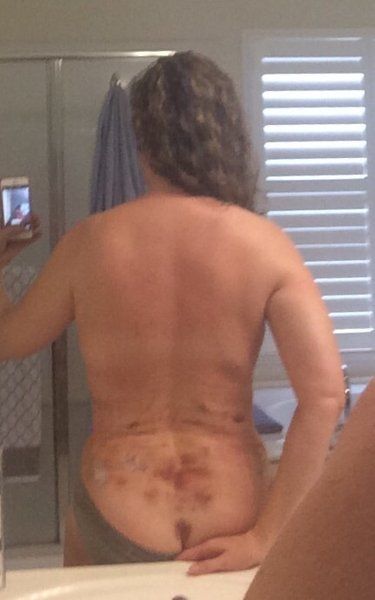 Cùng theo dõi quá trình hút bỡ hai bên hông, sườn và lưng của bà mẹ 46 tuổi