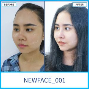 Hình ảnh nâng mũi trước sau Bs Trần Phương - Ca 1