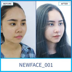 Hình ảnh nâng mũi trước sau Bs Trần Phương - Ca 1