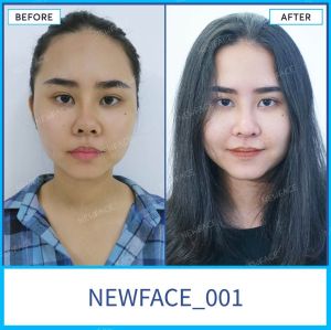 Hình ảnh nâng mũi trước sau Bs Trần Phương - Ca 1