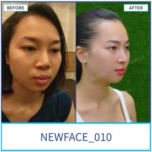 Hình ảnh nâng mũi trước sau Bs Trần Phương - Ca 10