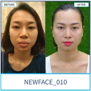 Hình ảnh nâng mũi trước sau Bs Trần Phương - Ca 10