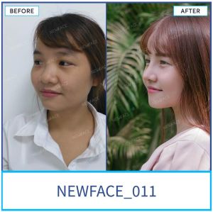 Hình ảnh nâng mũi trước sau Bs Trần Phương - Ca 11