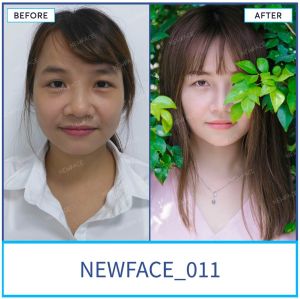 Hình ảnh nâng mũi trước sau Bs Trần Phương - Ca 11