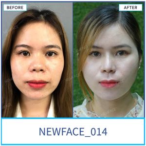 Hình ảnh nâng mũi trước sau Bs Trần Phương - Ca 14