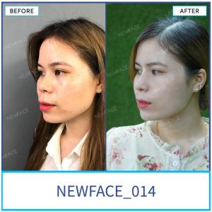 Hình ảnh nâng mũi trước sau Bs Trần Phương - Ca 14