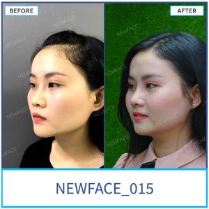 Hình ảnh nâng mũi trước sau Bs Trần Phương - Ca 15