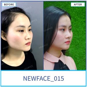 Hình ảnh nâng mũi trước sau Bs Trần Phương - Ca 15