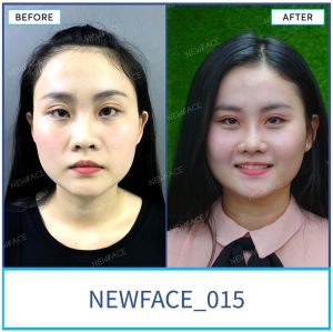 Hình ảnh nâng mũi trước sau Bs Trần Phương - Ca 15