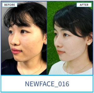 Hình ảnh nâng mũi trước sau Bs Trần Phương - Ca 16
