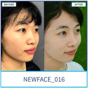 Hình ảnh nâng mũi trước sau Bs Trần Phương - Ca 16