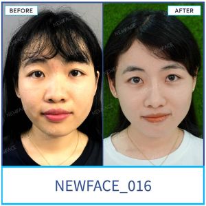 Hình ảnh nâng mũi trước sau Bs Trần Phương - Ca 16