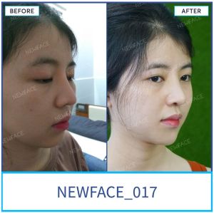 Hình ảnh nâng mũi trước sau Bs Trần Phương - Ca 17