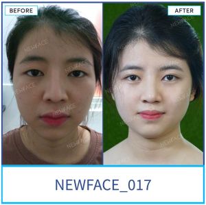 Hình ảnh nâng mũi trước sau Bs Trần Phương - Ca 17