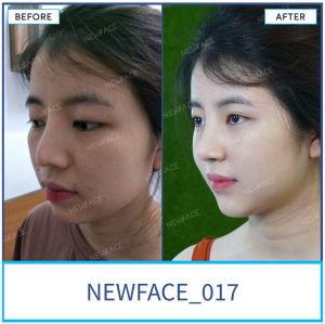 Hình ảnh nâng mũi trước sau Bs Trần Phương - Ca 17