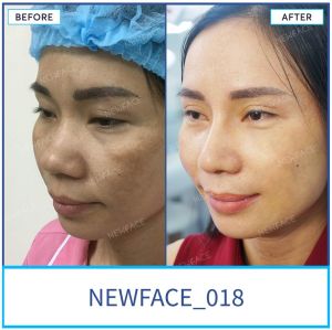 Hình ảnh nâng mũi trước sau Bs Trần Phương - Ca 18