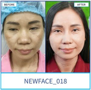 Hình ảnh nâng mũi trước sau Bs Trần Phương - Ca 18