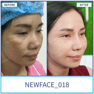 Hình ảnh nâng mũi trước sau Bs Trần Phương - Ca 18