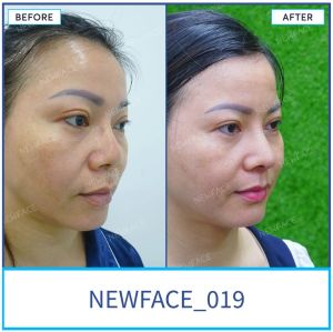 Hình ảnh nâng mũi trước sau Bs Trần Phương - Ca 19