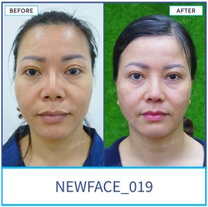 Hình ảnh nâng mũi trước sau Bs Trần Phương - Ca 19