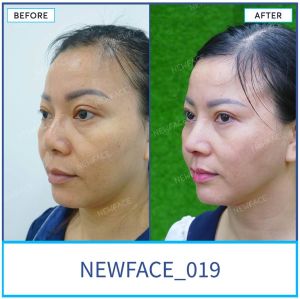 Hình ảnh nâng mũi trước sau Bs Trần Phương - Ca 19