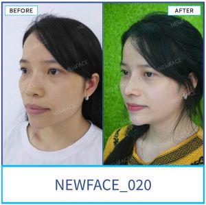 Hình ảnh nâng mũi trước sau Bs Trần Phương - Ca 20