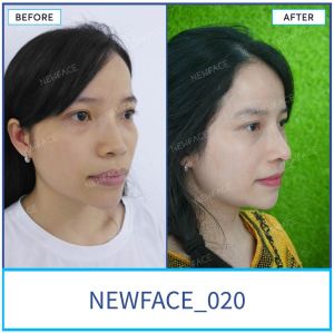 Hình ảnh nâng mũi trước sau Bs Trần Phương - Ca 20