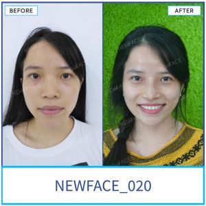 Hình ảnh nâng mũi trước sau Bs Trần Phương - Ca 20