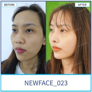 Hình ảnh nâng mũi trước sau Bs Trần Phương - Ca 23