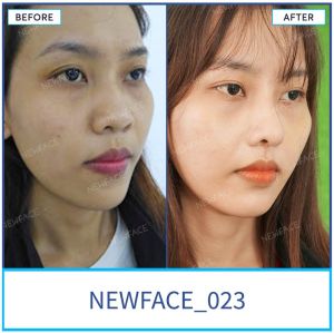 Hình ảnh nâng mũi trước sau Bs Trần Phương - Ca 23
