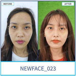 Hình ảnh nâng mũi trước sau Bs Trần Phương - Ca 23