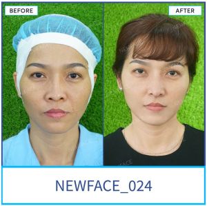 Hình ảnh nâng mũi trước sau Bs Trần Phương - Ca 24