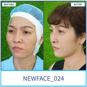 Hình ảnh nâng mũi trước sau Bs Trần Phương - Ca 24