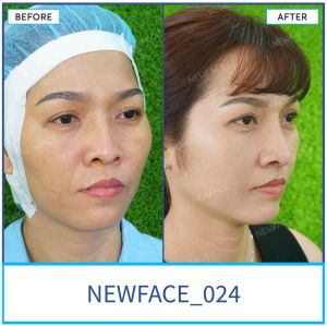 Hình ảnh nâng mũi trước sau Bs Trần Phương - Ca 24