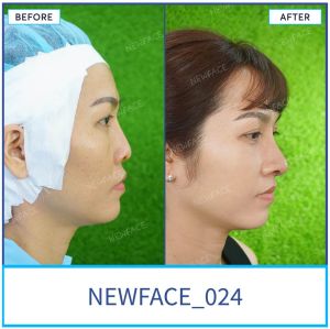 Hình ảnh nâng mũi trước sau Bs Trần Phương - Ca 24