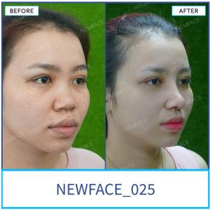 Hình ảnh nâng mũi trước sau Bs Trần Phương - Ca 25